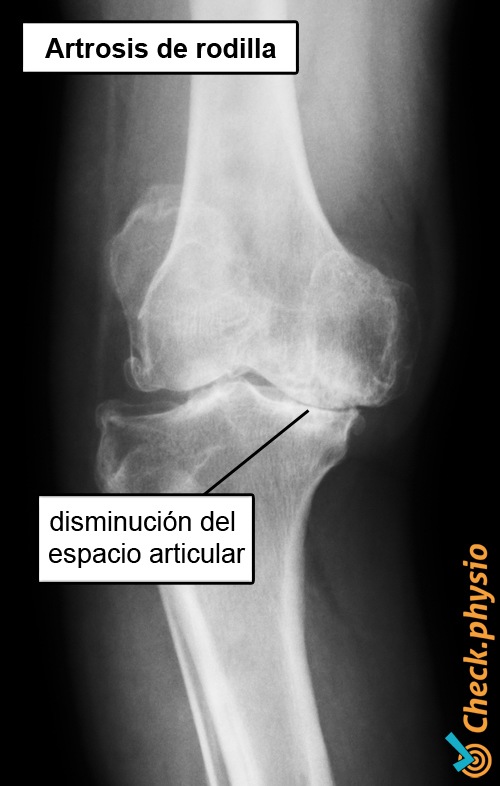 Artrosis de rodilla | Physio Check