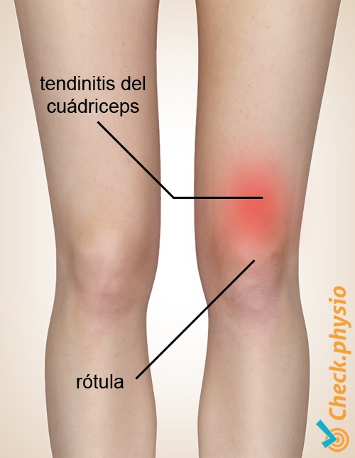 tendinitis del cuádriceps