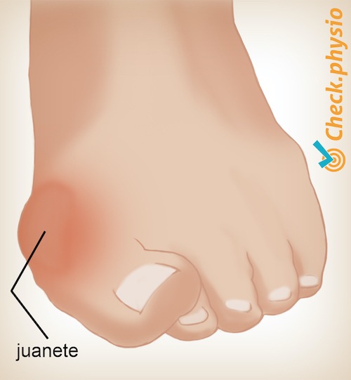 pie hallux valgus (juanete)