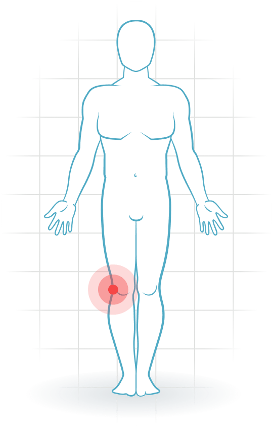 pijnlocatie Síndrome de la cintilla iliotibial