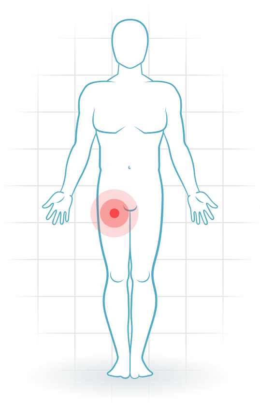 pijnlocatie Tendinopatía del recto femoral