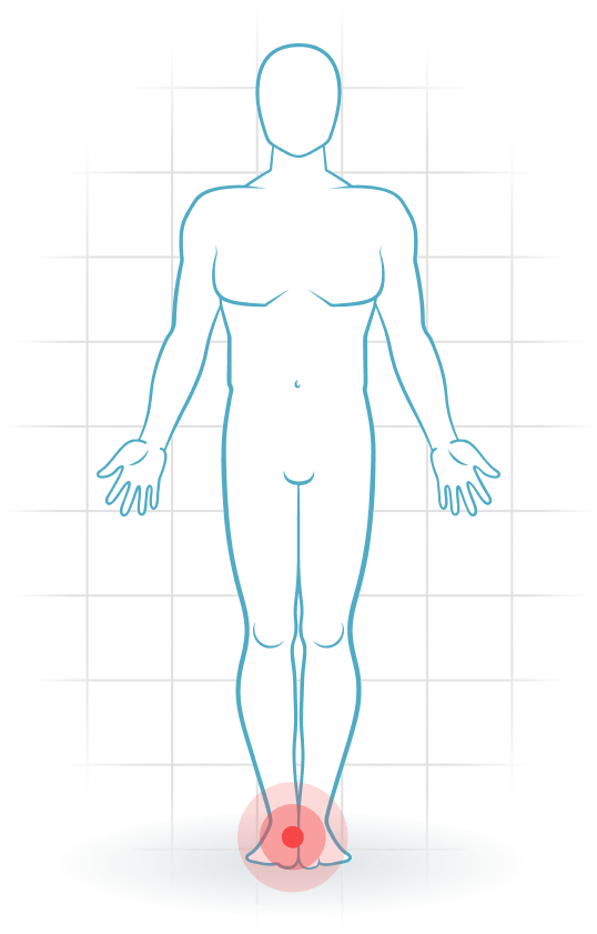 pijnlocatie Síndrome del túnel del tarso