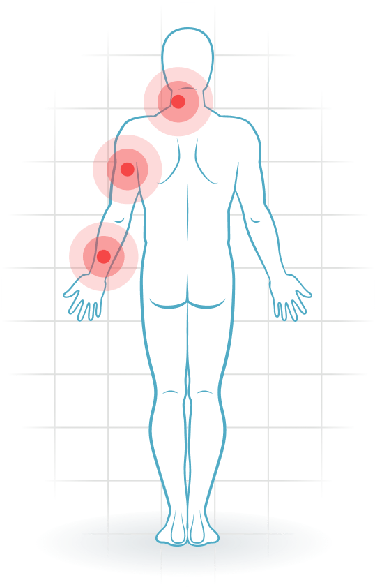 pijnlocatie Radiculopatía cervical